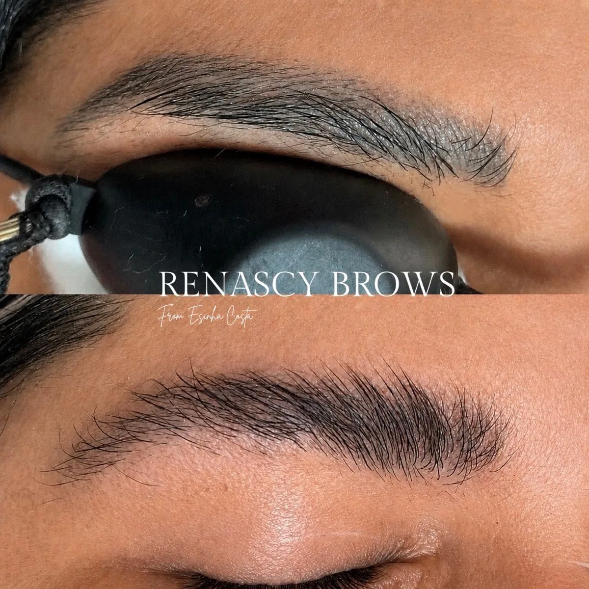 Antes e depois — reconstrução de sobrancelha